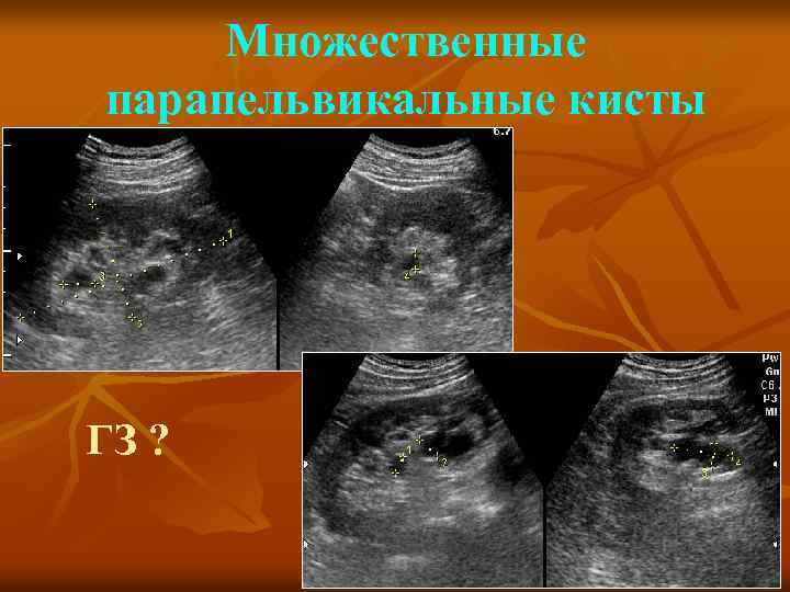 Множественные парапельвикальные кисты ГЗ ? 