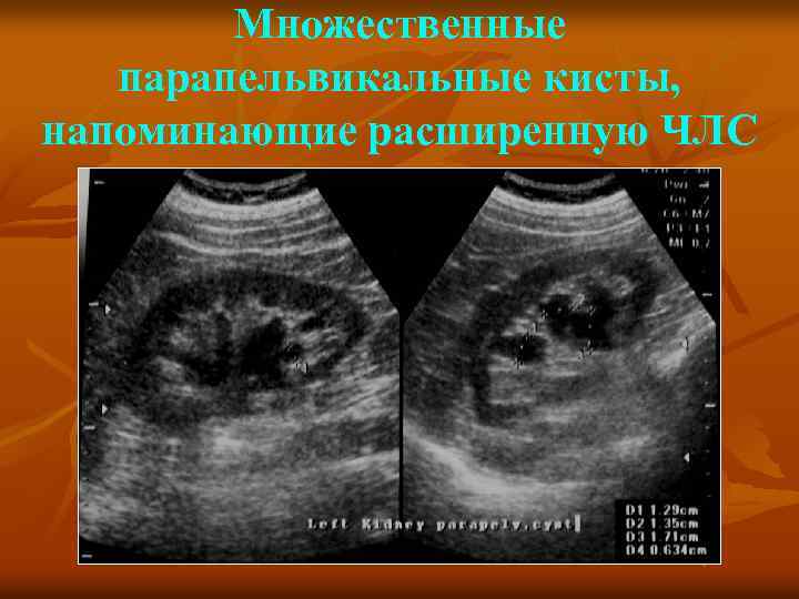 Множественные парапельвикальные кисты, напоминающие расширенную ЧЛС 