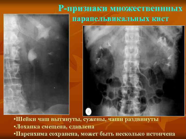 Р-признаки множественнных парапельвикальных кист • Шейки чаш вытянуты, сужены, чаши раздвинуты • Лоханка смещена,