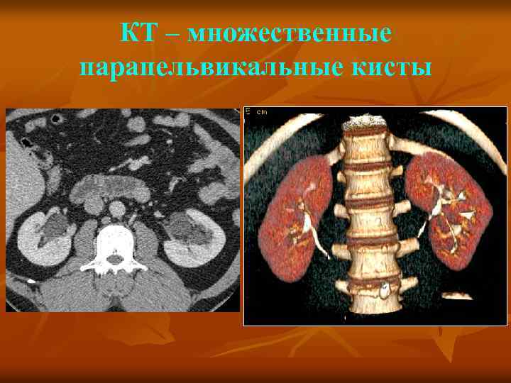 КТ – множественные парапельвикальные кисты 