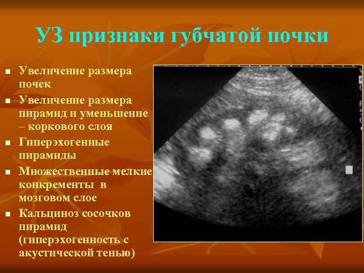 УЗ признаки губчатой почки n n n Увеличение размера почек Увеличение размера пирамид и