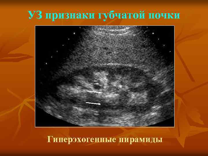 УЗ признаки губчатой почки Гиперэхогенные пирамиды 