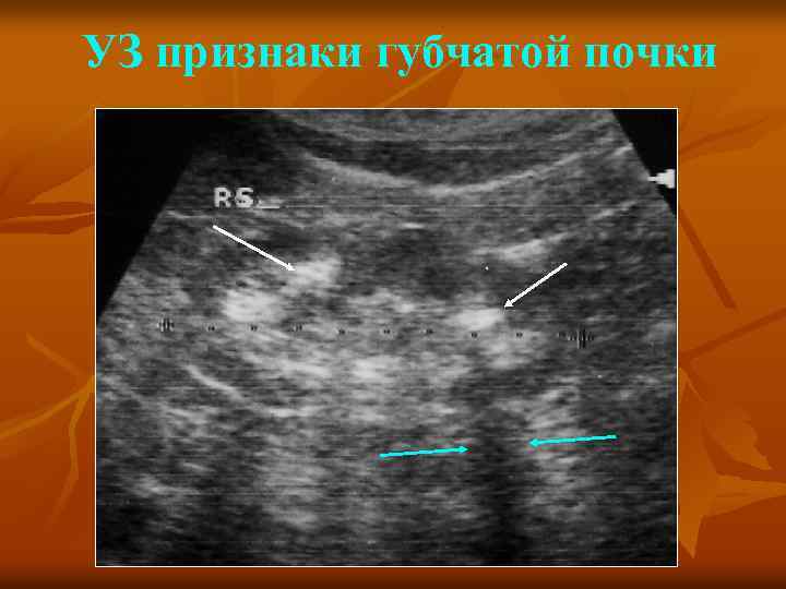 УЗ признаки губчатой почки 