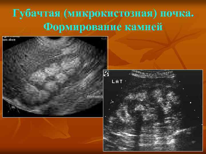 Губачтая (микрокистозная) почка. Формирование камней 