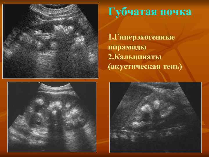 Губчатая почка 1. Гиперэхогенные пирамиды 2. Кальцинаты (акустическая тень) 