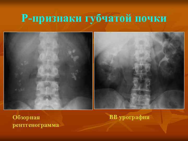 Р-признаки губчатой почки Обзорная рентгенограмма ВВ урография 