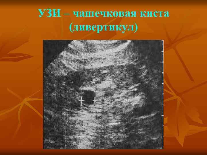 УЗИ – чашечковая киста (дивертикул) 