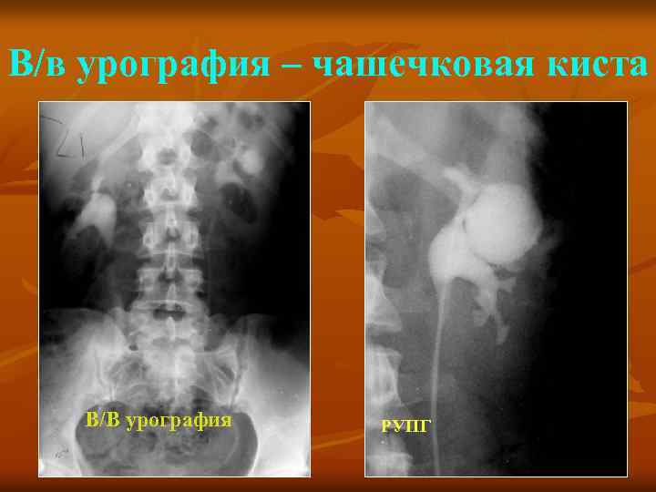 В/в урография – чашечковая киста В/В урография РУПГ 