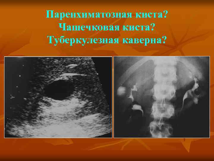 Паренхиматозная киста? Чашечковая киста? Туберкулезная каверна? 