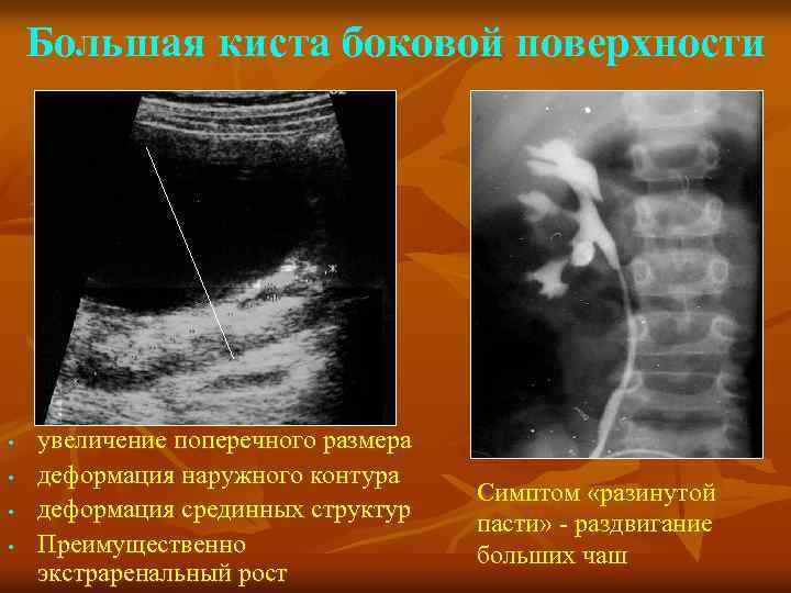 Большая киста боковой поверхности • • увеличение поперечного размера деформация наружного контура деформация срединных