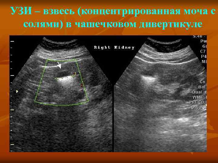 УЗИ – взвесь (концентрированная моча с солями) в чашечковом дивертикуле 