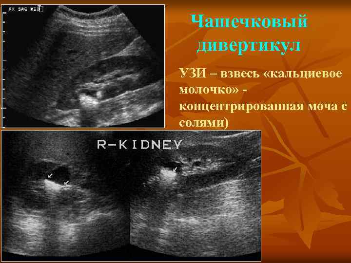 Чашечковый дивертикул УЗИ – взвесь «кальциевое молочко» концентрированная моча с солями) 