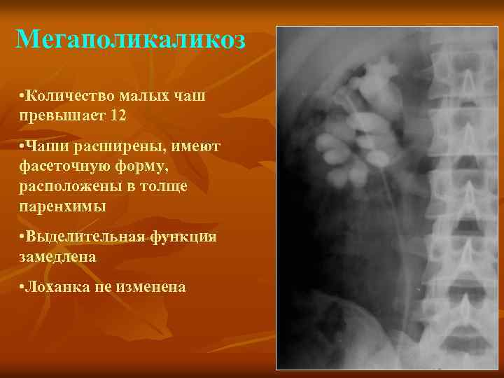Мегаполикаликоз • Количество малых чаш превышает 12 • Чаши расширены, имеют фасеточную форму, расположены