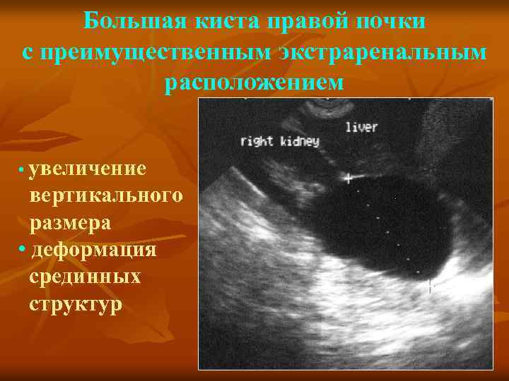 Большая киста правой почки с преимущественным экстраренальным расположением • увеличение вертикального размера • деформация