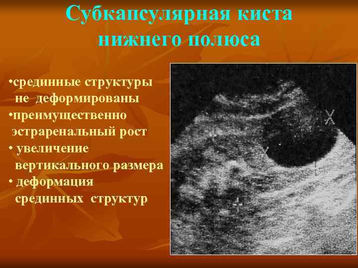 Субкапсулярная киста нижнего полюса • срединные структуры не деформированы • преимущественно эстраренальный рост •