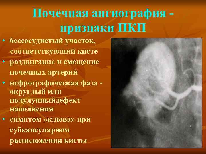 Почечная ангиография признаки ПКП • бессосудистый участок, соответствующий кисте • раздвигание и смещение почечных