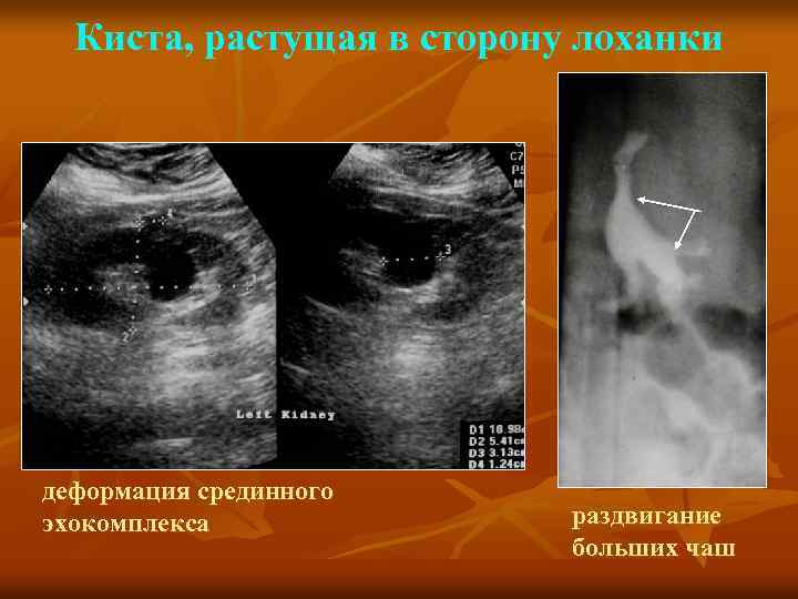 Киста, растущая в сторону лоханки деформация срединного эхокомплекса раздвигание больших чаш 