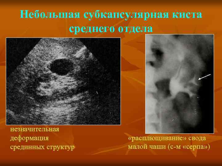 Небольшая субкапсулярная киста среднего отдела незначительная деформация срединных структур «расплющивание» свода малой чаши (с-м