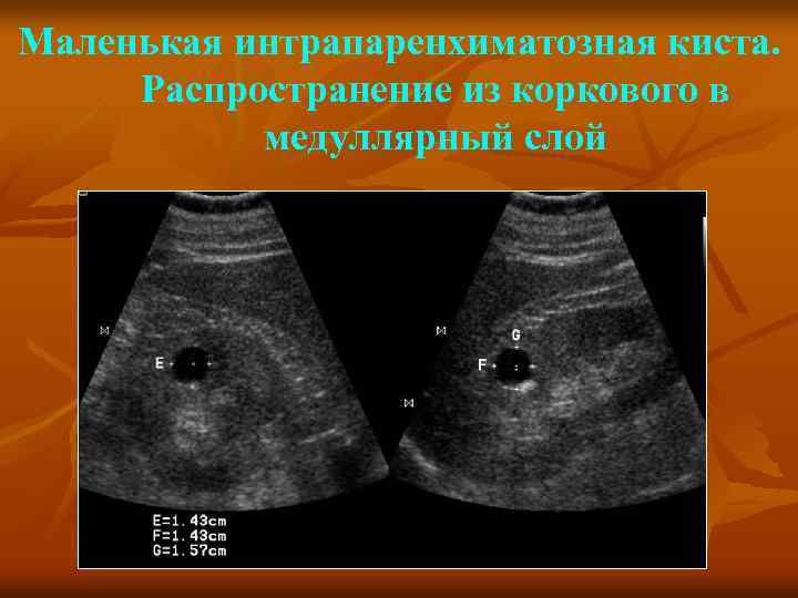 Маленькая интрапаренхиматозная киста. Распространение из коркового в медуллярный слой 
