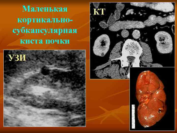Маленькая кортикальносубкапсулярная киста почки УЗИ КТ 