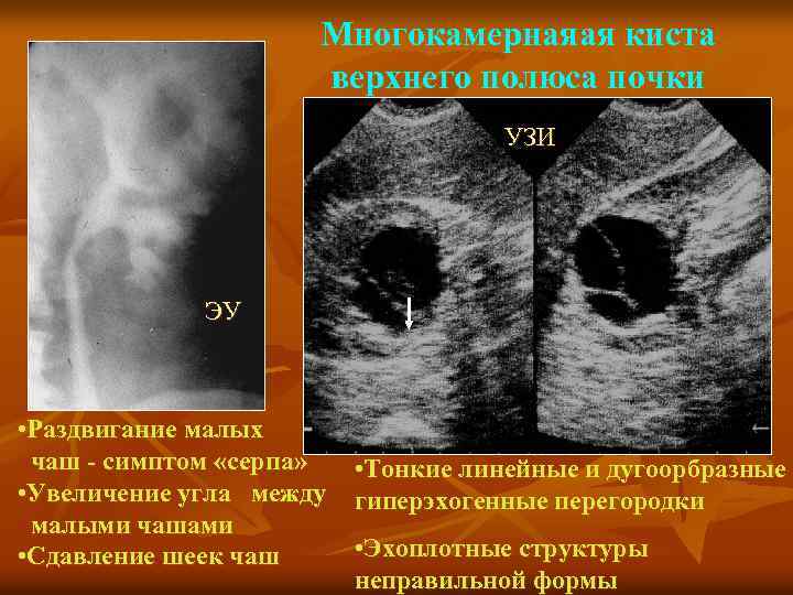 Многокамернаяая киста верхнего полюса почки УЗИ ЭУ • Раздвигание малых чаш - симптом «серпа»