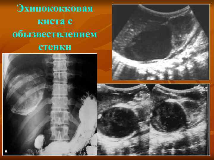 Эхинококковая киста печени в ультразвуковом изображении