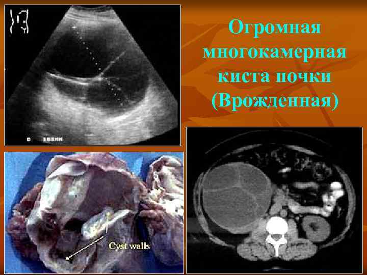 Огромная многокамерная киста почки (Врожденная) 