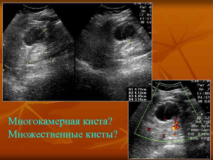 Многокамерная киста? Множественные кисты? 