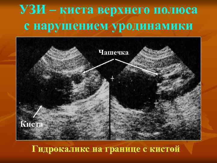 УЗИ – киста верхнего полюса с нарушением уродинамики Чашечка Киста Гидрокаликс на границе с