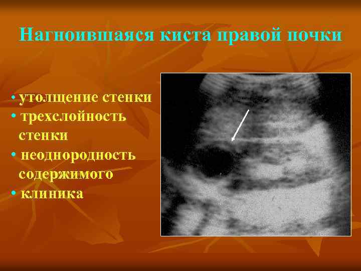 Нагноившаяся киста правой почки • утолщение стенки • трехслойность стенки • неоднородность содержимого •