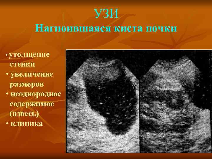 УЗИ Нагноившаяся киста почки • утолщение стенки • увеличение размеров • неоднородное содержимое (взвесь)