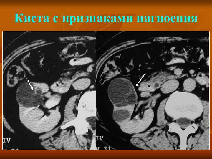 Киста с признаками нагноения 