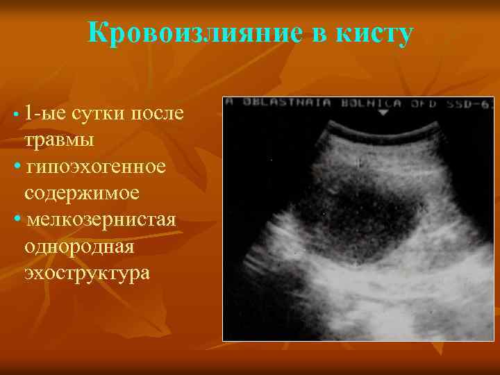 Кровоизлияние в кисту • 1 -ые сутки после травмы • гипоэхогенное содержимое • мелкозернистая