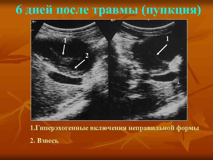 6 дней после травмы (пункция) 1 1 2 1. Гиперэхогенные включения неправильной формы 2.