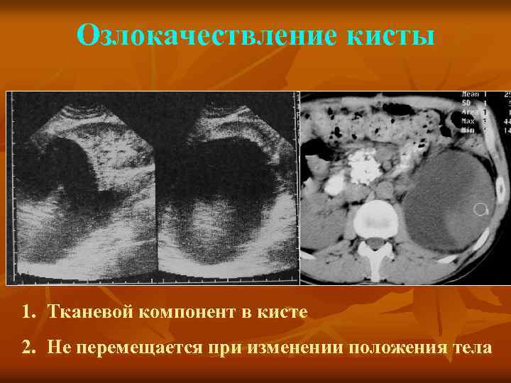 Озлокачествление кисты 1. Тканевой компонент в кисте 2. Не перемещается при изменении положения тела