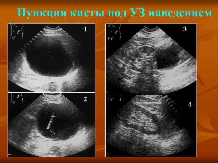 Пункция кисты под УЗ наведением 1 2 3 4 