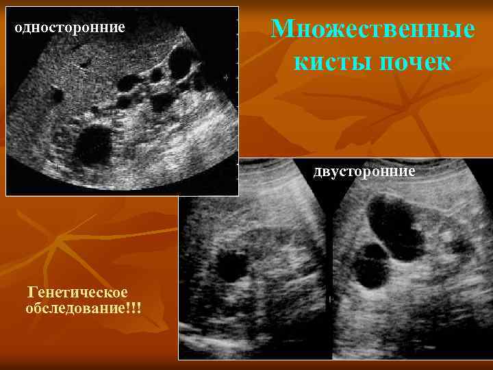 односторонние Множественные кисты почек двусторонние Генетическое обследование!!! 