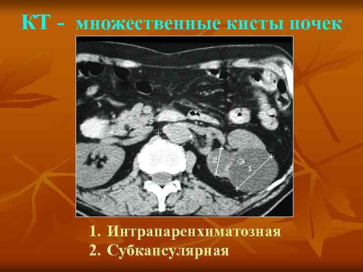 КТ - множественные кисты почек 1. Интрапаренхиматозная 2. Субкапсулярная 