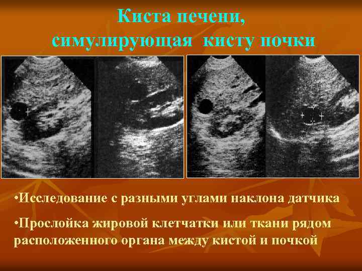 Киста печени, симулирующая кисту почки • Исследование с разными углами наклона датчика • Прослойка