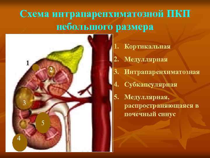 Схема интрапаренхиматозной ПКП небольшого размера 1. Кортикальная 2. Медуллярная 1 2 3. Интрапаренхиматозная 4.