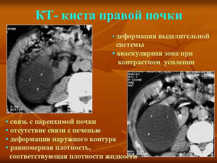 КТ- киста правой почки • деформация выделительной системы • аваскулярная зона при контрастном усилении