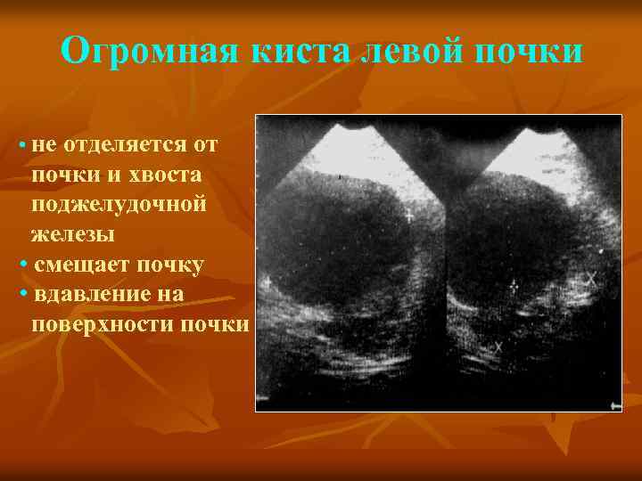 Огромная киста левой почки • не отделяется от почки и хвоста поджелудочной железы •