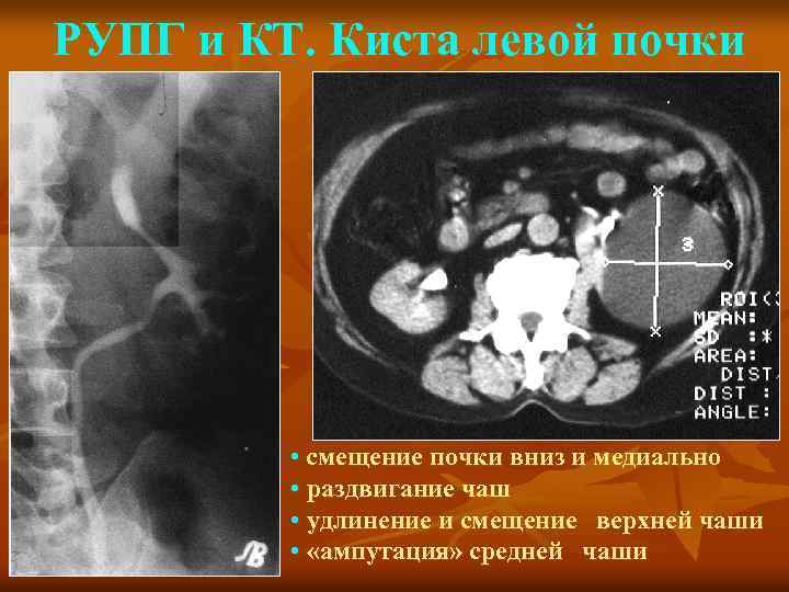 РУПГ и КТ. Киста левой почки • смещение почки вниз и медиально • раздвигание