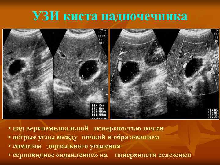 УЗИ киста надпочечника • над верхнемедиальной поверхностью почки • острые углы между почкой и