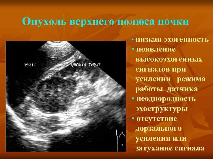 Опухоль верхнего полюса почки • низкая эхогенность • появление высокоэхогенных сигналов при усилении режима