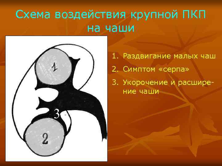 Схема воздействия крупной ПКП на чаши 1. Раздвигание малых чаш 2. Симптом «серпа» 3.