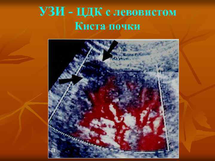 УЗИ - ЦДК с левовистом Киста почки 