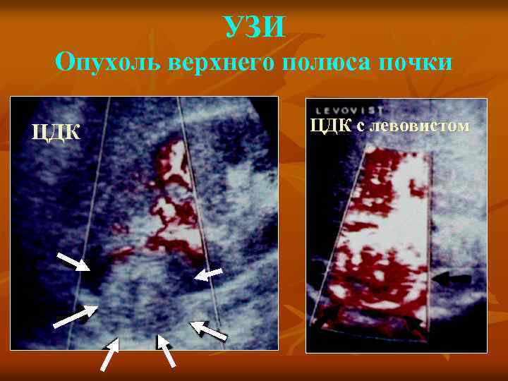 УЗИ Опухоль верхнего полюса почки ЦДК с левовистом 