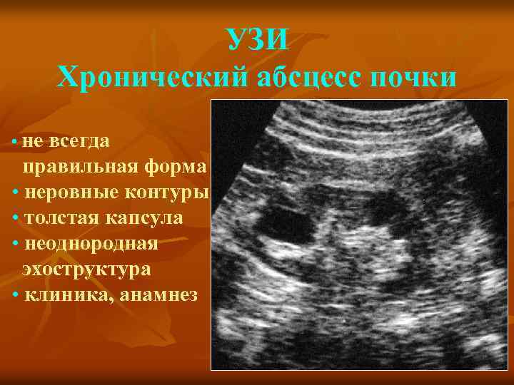 УЗИ Хронический абсцесс почки • не всегда правильная форма • неровные контуры • толстая