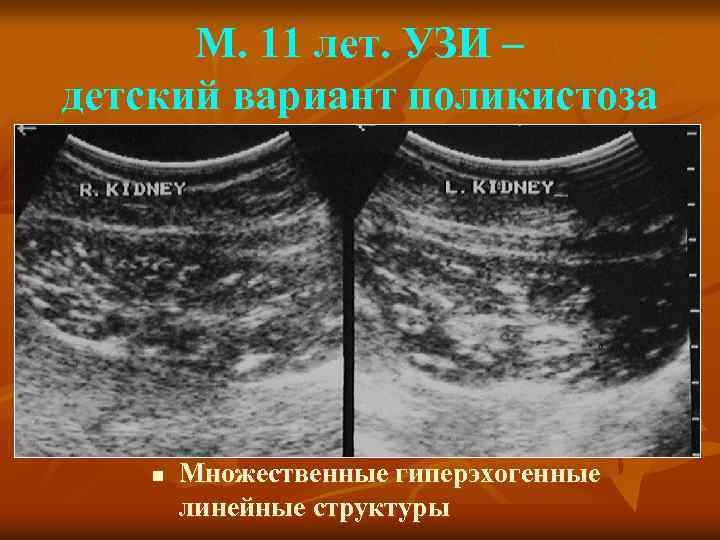 М. 11 лет. УЗИ – детский вариант поликистоза n Множественные гиперэхогенные линейные структуры 